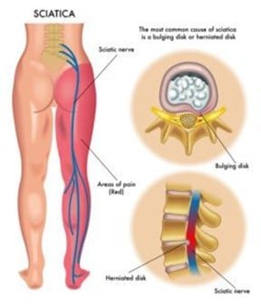 Diagram showing nerve pain from sciatica