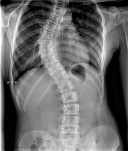 X-ray of Scoliosis